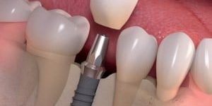 Single-Dental-Implant-300×240